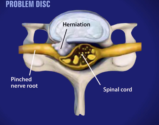 Posterior Cervical Foraminotomy