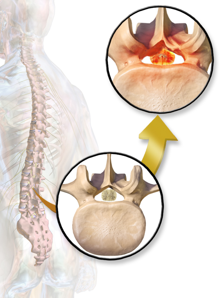 Minimally Invasive Lumbar Decompression